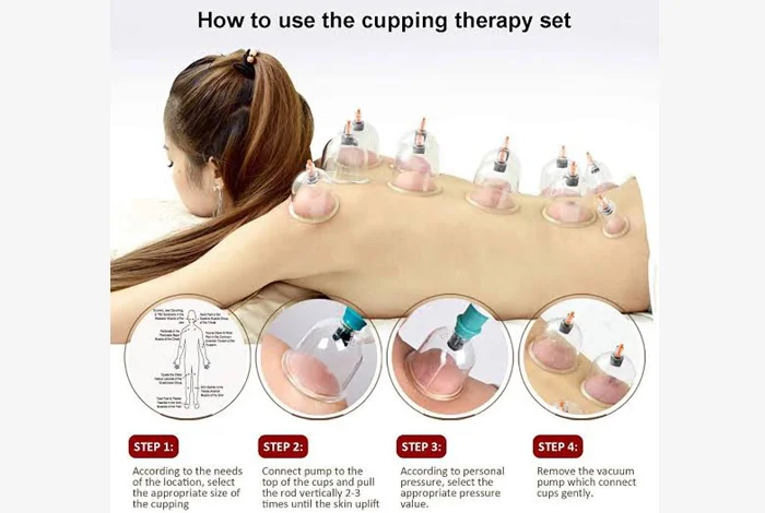 Cupping Therapy