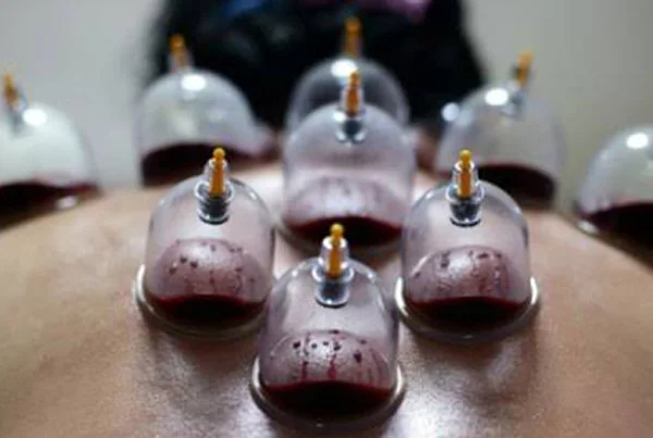 Wet Cupping / Hijama Therapy